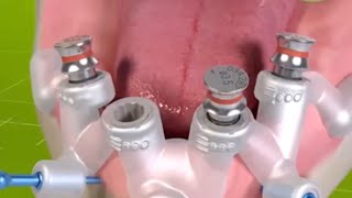 Implantes Dentários em 2024 [upl. by Nayd22]