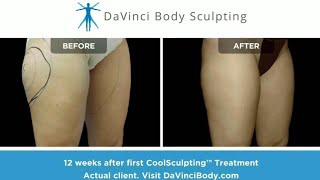 Can CoolSculpting Slim Your Thighs Real Before amp After Results [upl. by Ursola]