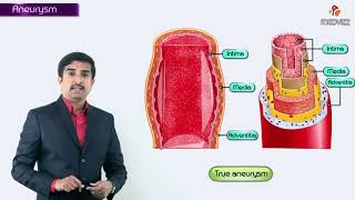 Aneurysms  Definition amp Types of aneursym  true  false  fusiform and saccular [upl. by Chemush]