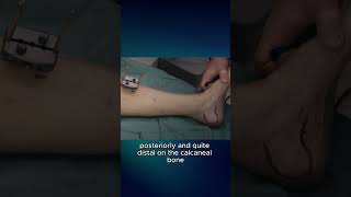 Ankle spanning external fixation  pin placement ortho trauma externalfixation medicaleducation [upl. by Atinas924]