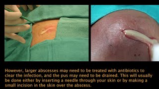 Abscess PEV [upl. by Ainsley990]