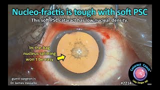 CataractCoach™ 2214 nucleofractis is tough with a soft PSC cataract [upl. by Grantham537]