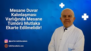 Mesane Duvar Kalınlaşması Varlığında Mesane Tümörü Mutlaka Ekarte Edilmelidir [upl. by Noby477]