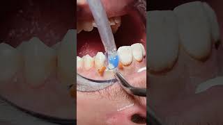 Deep tooth caries dentist satisfying [upl. by Lurie]