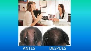 Centro Especializado en Tratamientos para la Caida del Pelo en Hombres y Mujeres  Adios Calvicie [upl. by Tove]