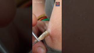 Botfly Removal From Squirrel [upl. by Beaston]