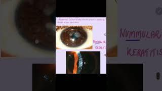 Nummular keratitis cornea keratitis eyes ophthalmology [upl. by Rocca]