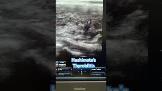 Hashimoto Thyroiditis reels videos thyroid hypothyroidism ultrasound ultraradiology [upl. by Tiffany]