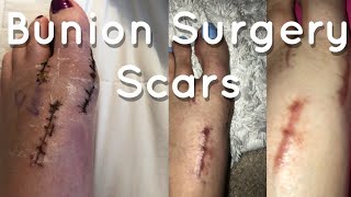 BUNION SURGERY EXPLAINED  PICTURES AND SCARS [upl. by Mahgem]