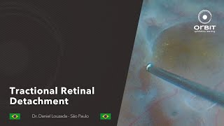 Tractional Retinal Detachment [upl. by Osei699]