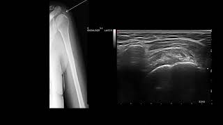 Ultrasound guided subacromial steroid injection calcific tendinitis and bursitis [upl. by Perretta]