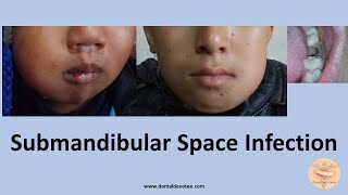 Submandibular Space Infection  Treatment by Dr Raman Dhungel [upl. by Serg]