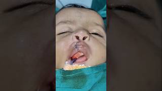 Best Surgeon For Cleft Lip and Nose Repair Surgery In India [upl. by Quennie]