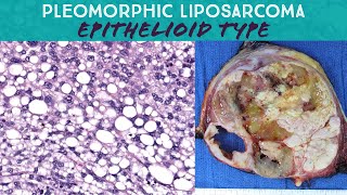 Pleomorphic liposarcoma epithelioid type Oregon Case 15 pathology sarcoma spindle cell neoplasm [upl. by Chapel]