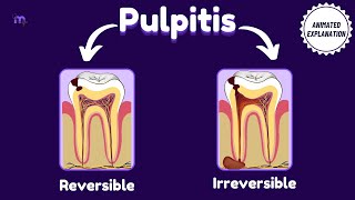 Reversible amp Irreversible pulpitis  Etiology  Classifications Diagnosis  Management Endodontics [upl. by Ybbob680]