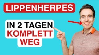 Lippenherpes in 2 Tagen komplett loswerden Meine Behandlung [upl. by Egief478]