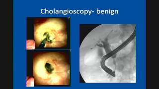 Primary Sclerosing Cholangitis Update in Management [upl. by Hoxsie]