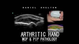 CS Arthritic Hand MCP amp PIP Pathology [upl. by Hsuk]