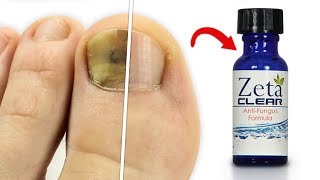 ZetaClear Reviews  Does It REALLY Work As A Permanent Solution To Nail Fungus [upl. by Aiksa]