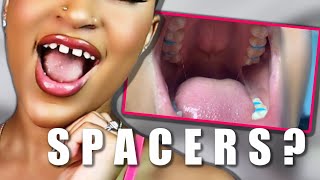 BRACES WITH MISSING TEETH  GETTING SPACERS FOR BRACES 2021 [upl. by Kieran]