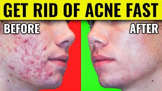 Say Goodbye to Acne Dr Bergs Proven Methods for Clearing Your Skin [upl. by Arette746]