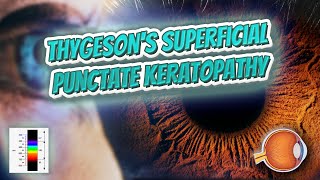 Thygesons superficial punctate keratopathy Your EYEBALLS 👁️👁️💉😳💊🔊💯✅ [upl. by Ahsiela17]