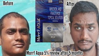 Morr F Aqua Minoxidil with Redensyl amp Procapil review after 5 months of use finasteride minoxidil [upl. by Ohce]