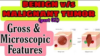 BENIGN vs MALIGNANT TUMOR on the basis of Gross amp Microscopic features  part 02 [upl. by Annoda]