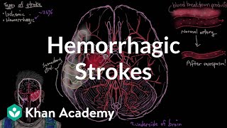 Hemorrhagic strokes  Circulatory System and Disease  NCLEXRN  Khan Academy [upl. by Sara]