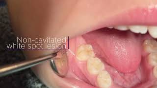 Curodont Repair Tutorial for Enamel Remineralization and Minimally Invasive Cavity Prevention [upl. by Ayekel777]