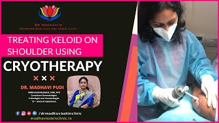 Keloids Treatment on Shoulder with Cryotherapy  Painless Cryotherapy Treatment  Dr Madhavi Pudi [upl. by Lebama552]