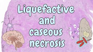 Liquefactive and caseous necrosis  general pathology [upl. by Acisseg306]