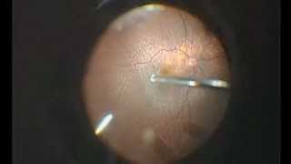 Vitrectomy for dropped lens fragments [upl. by Enelear843]