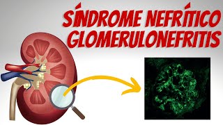 Síndrome Nefrítico  Glomerulonefritis Explicados Claramente [upl. by Olfe370]