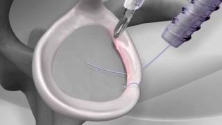 Knotless Shoulder Labral Repair with Arthrex® PushLock® [upl. by Sabella]