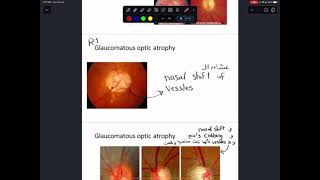 practical ophthalmology 2 [upl. by Edelson]