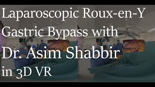 3D VR Laparoscopic RouxenY Gastric Bypass surgery Teaser [upl. by Desireah]