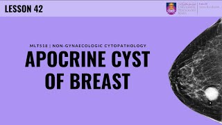 Apocrine Cysts of the Breast [upl. by Samau540]