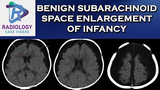 Benign Subarachnoid Space enlargement of infancy [upl. by Ari]