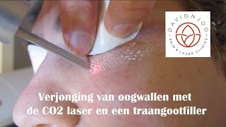 Verjonging van wallen onder de ogen met de CO2 laser en een traangootfiller [upl. by Paget]