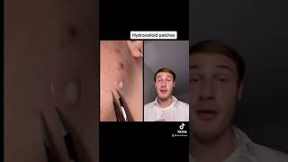 Reacting to Hydrocolloid Patch Removal Compilation shorts [upl. by Chaddy]