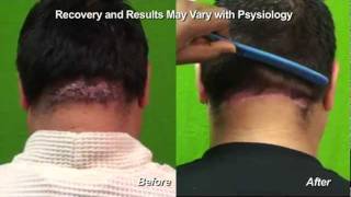 Surgical Cure for Acne Keloid Head Scar Acne Keloidalis Nuchae by Dr Umar [upl. by Rayburn]