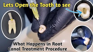 Root Canal Treatment Demonstration  Root Canal Procedure  RCT  Endodontics [upl. by Demetre794]