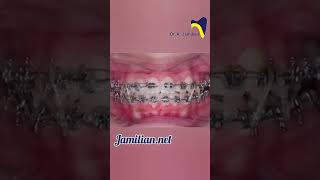 From Misaligned to Magnificent The Miracle of Modern Orthodontics orthodonticsbrace orthodontist [upl. by Gerladina]