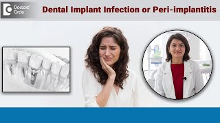 Warning Signs of Infection around Dental Implant  PeriImplantitis DrAditi Garg  Doctors’ Circle [upl. by Nwatna646]