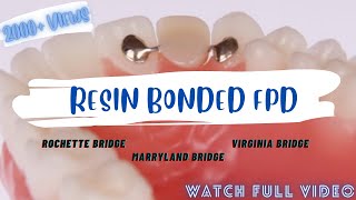 RESIN BONDED FPD  ROCHETTE BRIDGE  MARRYLAND BRIDGE  VIRGINIA BRIDGE fpd prostho [upl. by Cryan207]