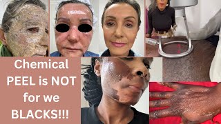 MUST WATCH Phenol Peel Extreme chemical peel for wrinklesLook 20years youngerhow it worksblack [upl. by Zaob]