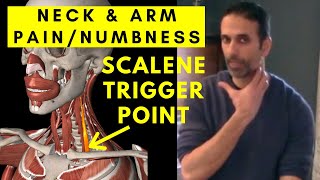 NECK amp ARM pain Relief Scalene Muscle Trigger Points [upl. by Eusadnilem]