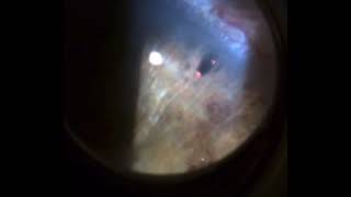 IRIDOTOMIA YAG LASER [upl. by Lammond]