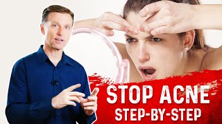 How To Get Rid Of Acne Eliminate Acne Permanently – DrBerg [upl. by Etolas]